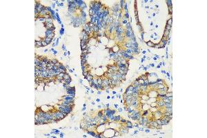 Immunohistochemistry of paraffin-embedded Human colon carcinoma using USP47 Rabbit pAb (ABIN7271166) at dilution of 1:100 (40x lens). (USP47 antibody  (AA 1128-1287))