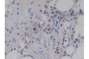 DAB staining on IHC-P; Samples: Human Skin cancer Tissue (CSF2RA antibody  (AA 28-112))