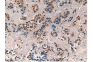 Detection of CXCL7 in Human Breast cancer Tissue using Polyclonal Antibody to Chemokine (C-X-C motif) ligand 7 ( CXCL7) (CXCL7 antibody  (AA 59-128))