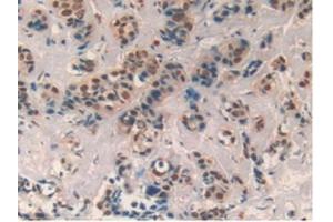 Detection of CXCL7 in Human Breast cancer Tissue using Polyclonal Antibody to Chemokine (C-X-C motif) ligand 7 ( CXCL7)