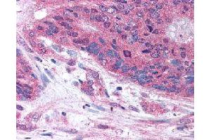 Immunohistochemical (Formalin/PFA-fixed paraffin-embedded sections) staining in human colon carcinoma with PLA2G3 polyclonal antibody . (PLA2G3 antibody)