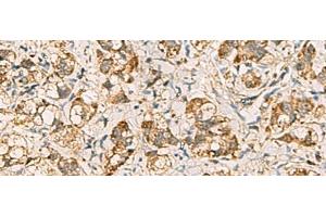 Immunohistochemistry of paraffin-embedded Human liver cancer tissue using VTA1 Polyclonal Antibody at dilution of 1:60(x200) (VTA1 antibody)