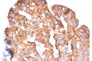 Formalin-fixed, paraffin-embedded human Breast Carcinoma stained with HER-2 Mouse Monoclonal Antibody (ERBB2/2452). (ErbB2/Her2 antibody  (AA 311-462))