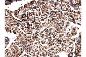 IHC-P Image MTA1 antibody [C1C3] detects MTA1 protein at nucleus on human breast carcinoma by immunohistochemical analysis. (MTA1 antibody)