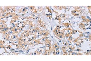 Immunohistochemistry of paraffin-embedded Human thyroid cancer tissue using CCR9 Polyclonal Antibody at dilution 1:60 (CCR9 antibody)