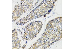 Immunohistochemistry of paraffin-embedded human esophageal cancer using IKBKG antibody (ABIN5970336) at dilution of 1/100 (40x lens). (IKBKG antibody)