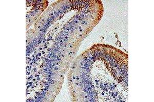 Immunohistochemical analysis of CD212 staining in human colon cancer formalin fixed paraffin embedded tissue section. (IL12RB1 antibody)