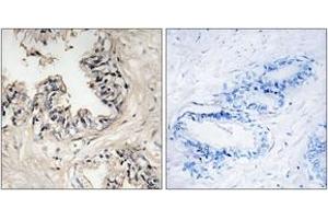 Immunohistochemistry analysis of paraffin-embedded human prostate carcinoma tissue, using MRPS36 Antibody. (MRPS36 antibody  (AA 4-53))