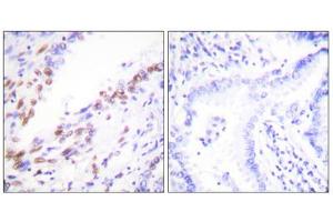 Immunohistochemistry analysis of paraffin-embedded human lung carcinoma tissue, using Ki67antibody. (Ki-67 antibody  (C-Term))