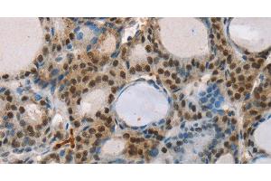 Immunohistochemistry of paraffin-embedded Human thyroid cancer tissue using RUNX1T1 Polyclonal Antibody at dilution 1:35 (RUNX1T1 antibody)