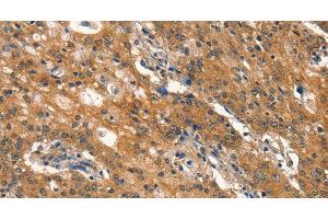 Immunohistochemistry of paraffin-embedded Human gastic cancer using DNM2 Polyclonal Antibody at dilution of 1:40 (DNM2 antibody)