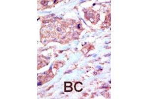 Formalin-fixed and paraffin-embedded human cancer tissue reacted with the primary antibody, which was peroxidase-conjugated to the secondary antibody, followed by DAB staining. (EPH Receptor B6 antibody  (C-Term))