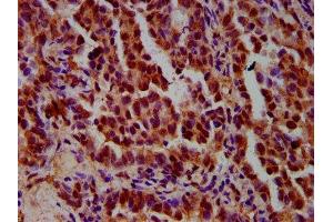 IHC image of ABIN7156289 diluted at 1:600 and staining in paraffin-embedded human lung cancer performed on a Leica BondTM system. (IMPDH1 antibody  (AA 191-281))