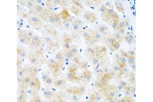 Immunohistochemistry of paraffin-embedded Human liver cancer using DHODH Polyclonal Antibody at dilution of 1:100 (40x lens). (DHODH antibody)