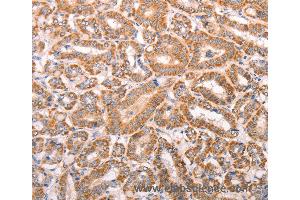 Immunohistochemistry of Human liver cancer using TRPV4 Polyclonal Antibody at dilution of 1:40