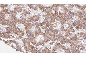 ABIN6279168 at 1/100 staining Human liver cancer tissue by IHC-P. (ABCC8 antibody)