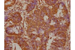 IHC image of ABIN7164792 diluted at 1:100 and staining in paraffin-embedded human colon cancer performed on a Leica BondTM system. (PREP antibody  (AA 539-691))