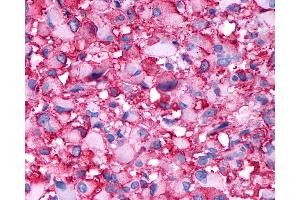 Anti-DRD4 / Dopamine Receptor D4 antibody IHC of human Brain, Glioblastoma. (DRD4 antibody  (C-Term))