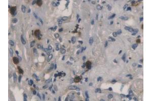 DAB staining on IHC-P; Samples: Human Lung cancer Tissue (RNASE3 antibody  (AA 30-154))