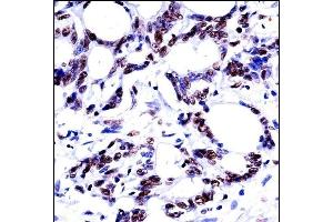 HNRN Antibody (N-term) ((ABIN657930 and ABIN2846875))immunohistochemistry analysis in formalin fixed and paraffin embedded human colon carcinoma followed by peroxidase conjugation of the secondary antibody and DAB staining. (HNRNPM antibody  (N-Term))