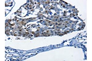 The image on the left is immunohistochemistry of paraffin-embedded Human breast cancer tissue using ABIN7190003(BPIFB1 Antibody) at dilution 1/25, on the right is treated with synthetic peptide. (BPIFB1 antibody)
