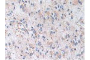 IHC-P analysis of Human Glioma Tissue, with DAB staining. (AKAP11 antibody  (AA 1650-1901))