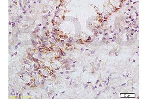 Formalin-fixed and paraffin embedded: human rectal carcinoma labeled with Anti-FasL Polyclonal Antibody, Unconjugated (ABIN726410) at 1:200, followed by conjugation to the secondary antibody and DAB staining (FASL antibody  (AA 196-281))