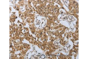 Immunohistochemistry of Human lung cancer using PSMD6 Polyclonal Antibody at dilution of 1:40