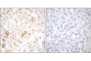 Immunohistochemistry analysis of paraffin-embedded human breast carcinoma tissue, using Cyclin F Antibody. (Cyclin F antibody  (AA 737-786))