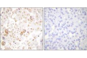 Immunohistochemistry analysis of paraffin-embedded human breast carcinoma tissue, using Cyclin F Antibody.