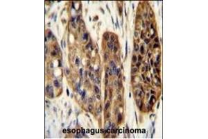 KIL Antibody (N-term) (ABIN654924 and ABIN2844567) immunohistochemistry analysis in formalin fixed and paraffin embedded human esophagus carcinoma followed by peroxidase conjugation of the secondary antibody and DAB staining. (KIAA1324-Like antibody  (N-Term))