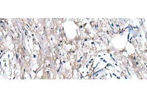 Immunohistochemistry of paraffin-embedded Human gastric cancer tissue using WRN Polyclonal Antibody at dilution of 1:55(x200) (RECQL2 antibody)