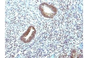 Formalin-fixed, paraffin-embedded human uterine carcinoma stained with MAP3K1 antibody (2F6). (MAP3K1 antibody  (AA 1211-1310))