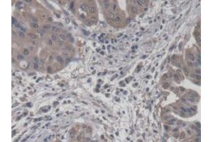 DAB staining on IHC-P; Samples: Human Liver cancer Tissue (CROT antibody  (AA 410-612))