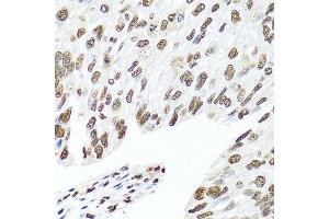 Immunohistochemistry of paraffin-embedded human prostate cancer using HNRNPR antibody at dilution of 1:100 (40x lens). (HNRNPR antibody)