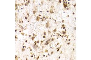 Immunohistochemistry of paraffin-embedded human liver cancer using PRPF3 Antibody (ABIN1876670) at dilution of 1:100 (40x lens). (PRPF3 antibody)