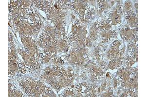 IHC analysis of formalin-fixed paraffin-embedded liver cancer tissue with cytoplasmic staining, using FUCA2 antibody (1/100 dilution). (FUCA2 antibody  (AA 312-467))