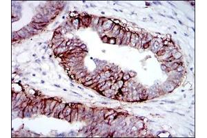 Immunohistochemical analysis of paraffin-embedded ovarian cancer tissues using IGF1R antibody with DAB staining.