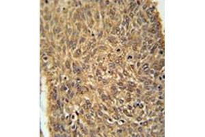 Immunohistochemistry analysis in formalin fixed and paraffin embedded human lung carcinoma reacted with KIAA0652 Antibody (N-term) followed which was peroxidase conjugated to the secondary antibody and followed byDAB staining. (ATG13 antibody  (N-Term))