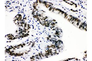 Anti-CTBP2 Picoband antibody, IHC(P) IHC(P): Human Intestinal Cancer Tissue (CTBP2 antibody  (AA 321-445))