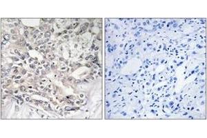 Immunohistochemistry analysis of paraffin-embedded human liver carcinoma tissue, using APOL5 Antibody. (Apolipoprotein L 5 antibody  (AA 384-433))