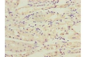 Immunohistochemistry of paraffin-embedded human gastric cancer using ABIN7167348 at dilution of 1:100 (RAB4B antibody  (AA 2-213))