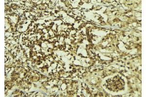 ABIN6267213 at 1/100 staining Human breast cancer tissue by IHC-P.