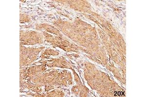 IHC staining of human leiomyosarcoma (20X) with Muscle actin antibody (HHF35).