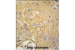 Formalin-fixed and paraffin-embedded human lung carcinoma tissue reacted with MCK10 antibody (ABIN392016 and ABIN2841793) , which was peroxidase-conjugated to the secondary antibody, followed by DAB staining. (DDR1 antibody)
