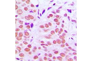 Immunohistochemical analysis of c-Jun (pT91) staining in human breast cancer formalin fixed paraffin embedded tissue section.