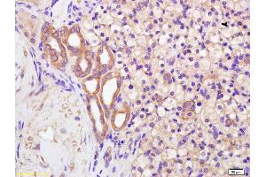 Formalin-fixed and paraffin embedded human kidney carcinoma labeled with Anti-Polycystin 2 Polyclonal Antibody, Unconjugated (ABIN678098) at 1:200 followed by conjugation to the secondary antibody and DAB staining. (PKD2 antibody  (AA 651-750))