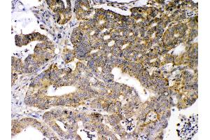 GAD65 was detected in paraffin-embedded sections of human intetsinal cancer tissues using rabbit anti- GAD65 Antigen Affinity purified polyclonal antibody (Catalog #) at 1 µg/mL. (GAD65 antibody  (N-Term))