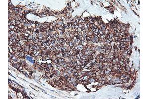 Immunohistochemical staining of paraffin-embedded Adenocarcinoma of Human breast tissue using anti-CYP2B6 mouse monoclonal antibody.