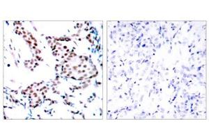 Immunohistochemical analysis of paraffin-embedded human breast carcinoma tissue using c-Jun (Ab-170) antibody (E021023). (C-JUN antibody)